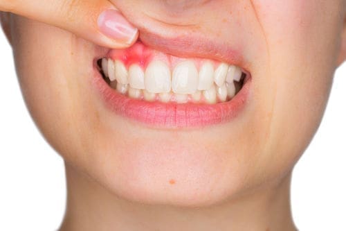 Periodontal disease Lexington MA | Gum Disease Lexington MA