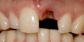 dental implant Lexington MA