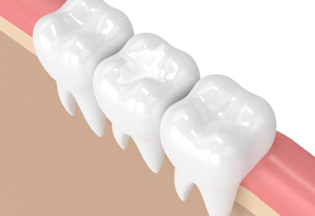 dental fillings | composite dental fillings Lexington MA