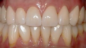 porcelain dental crowns Lexington MA