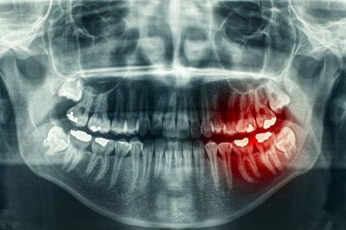 Dental X-rays Lexington MA