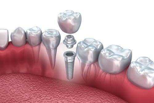 Teeth replacement | dental implants Lexington MA