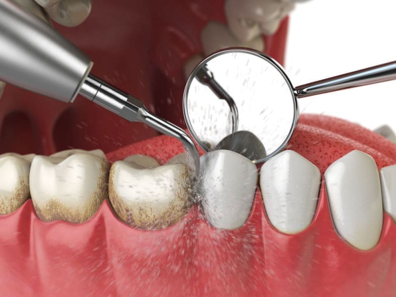 Tartar removed during a dental cleaning | Lexington dentists
