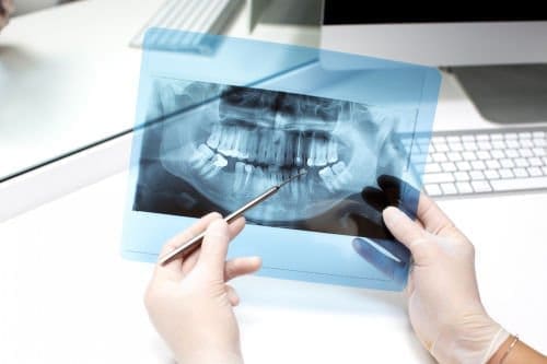 prosthodontics in lexington | dental x-ray